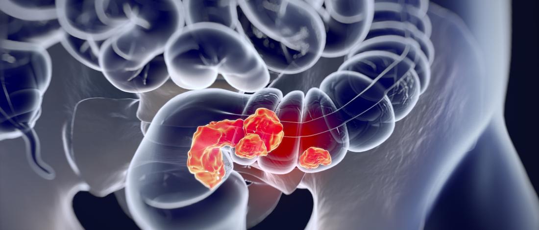 Colorectal Cancer